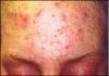 بازگشت سالک/ زخم کهنه ای که دوباره سر باز کرد