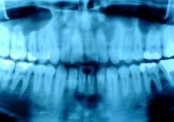 Iranian researchers reconstruct defected mandible using brain death bones, cell therapy