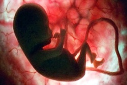 Iran successful heart valve surgery on a 28-weeks-old fetus